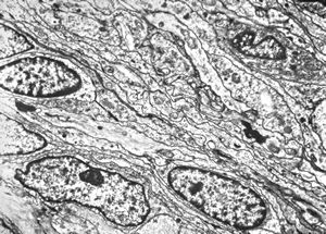 M,55y. | meningotheliomatous meningeoma